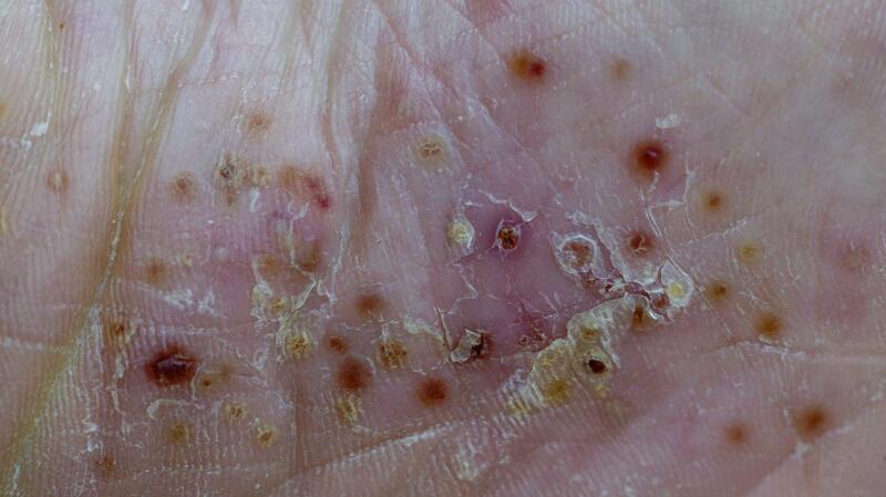 Psoriasis: Symptoms, Causes, Pictures, and Treatments