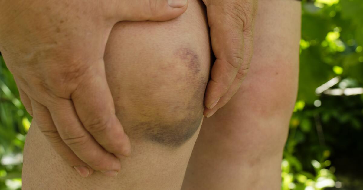 Bruise vs. How to Tell the Difference