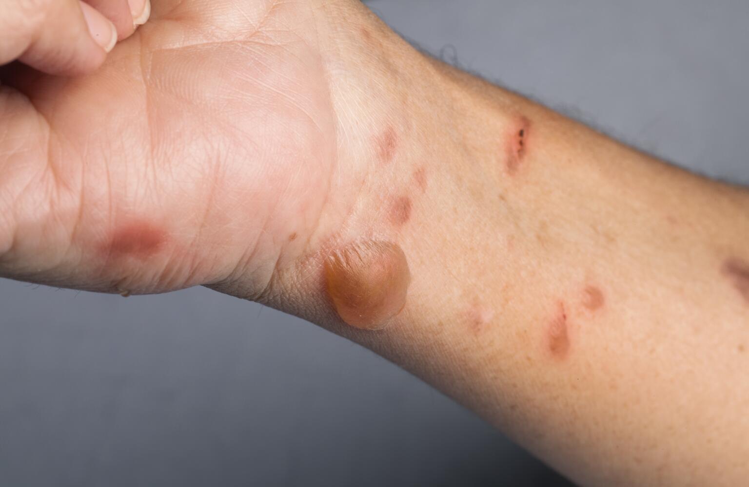Blisters - Symptoms, Causes, Treatments