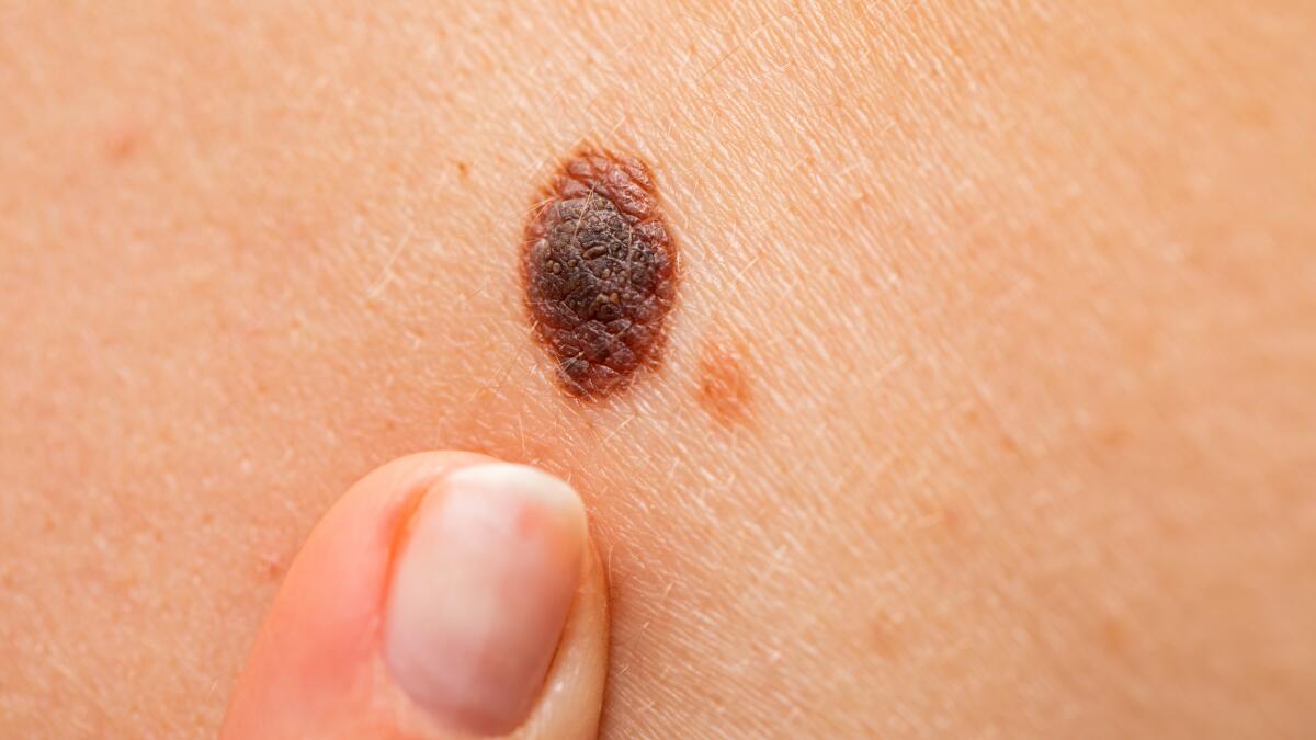How to Identify Atypical Moles | Dysplastic Nevi & Benign Moles How to Identify Atypical Moles | Dysplastic Nevi & Benign Moles