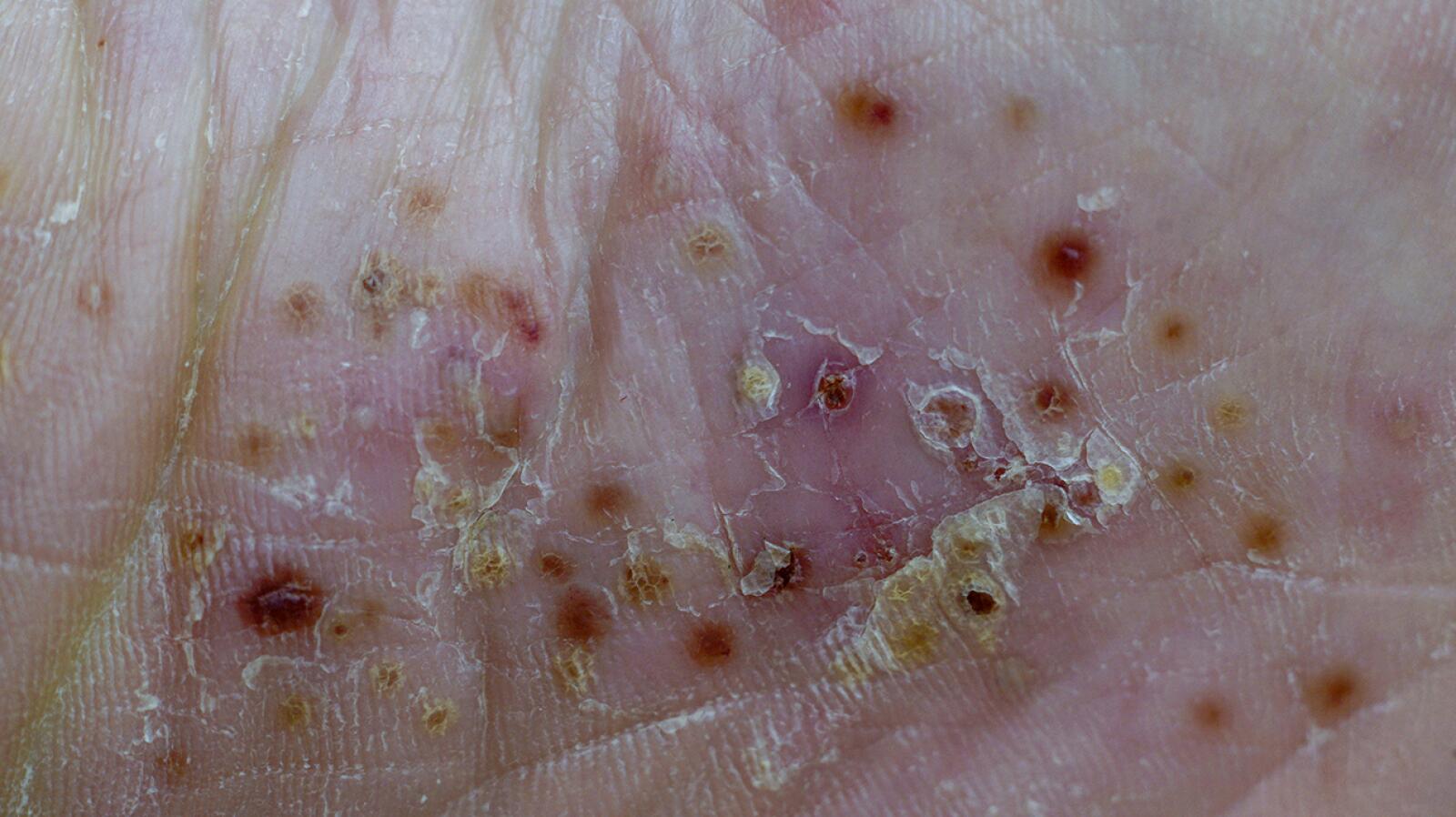 Psoriasis Symptoms, Causes, Pictures, and Treatments