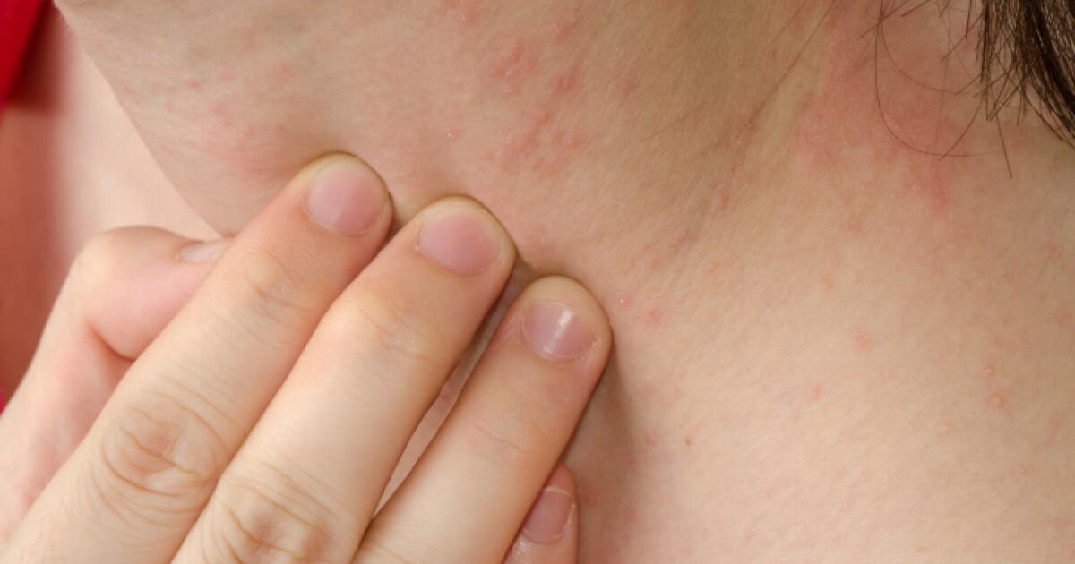 pics Rash On Back Of Neck Under Hairline