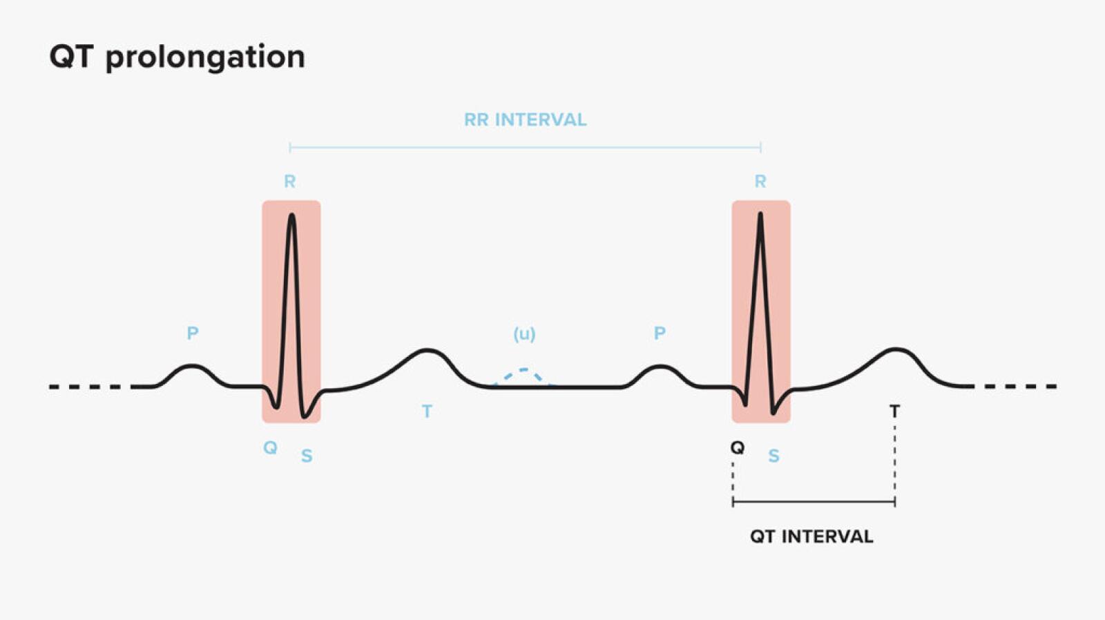 Qt Inter Long QT Syndrome: Symptoms, Causes, and Managing LQTS