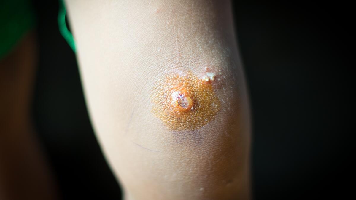 A hybrid case of eosinophilic folliculitis and eosinophilic cellulitis  associated with hypereosinophilic syndrome - Iatropoulou - 2024 - Skin  Health and Disease - Wiley Online Library, image size:1200x675