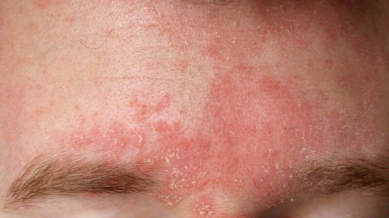 Facial Eczema: Symptoms, Causes, 2 Treatments