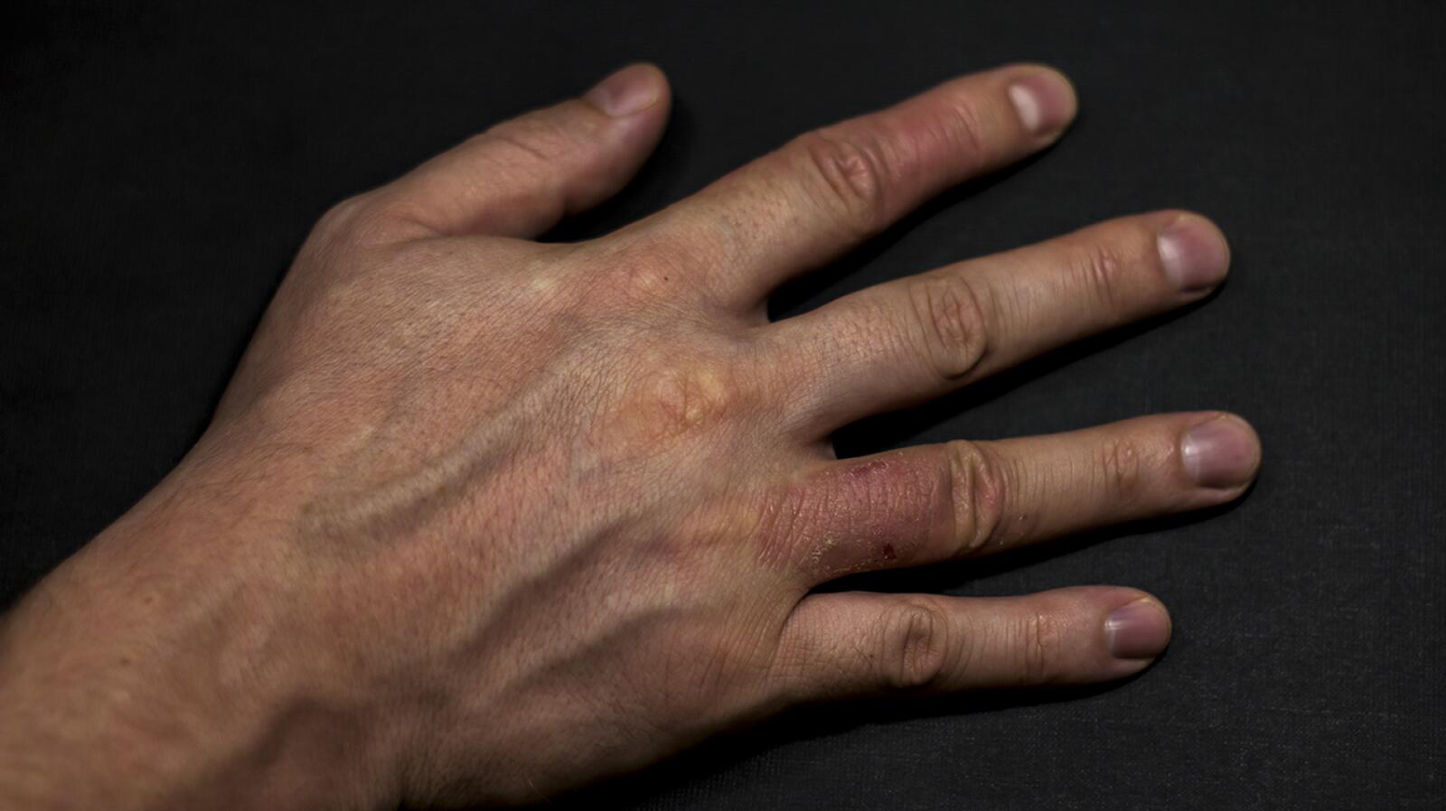 Dyshidrotic Eczema Symptoms, Causes, and More