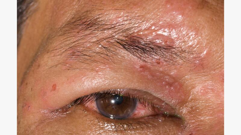 Shingles In The Eye Signs Treatment Outlook And More 