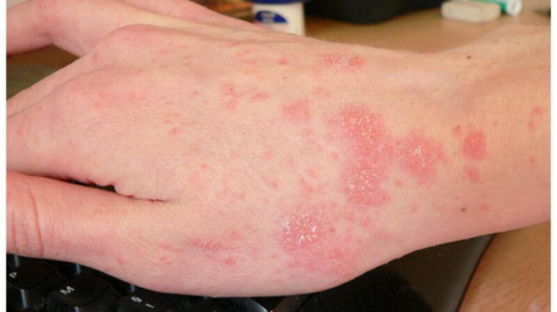 red blotches on white skin from scabies infestation