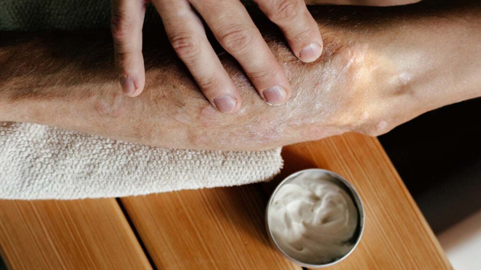 Psoriatic Arthritis Rash: Pictures, Causes, Symptoms, and Treatments