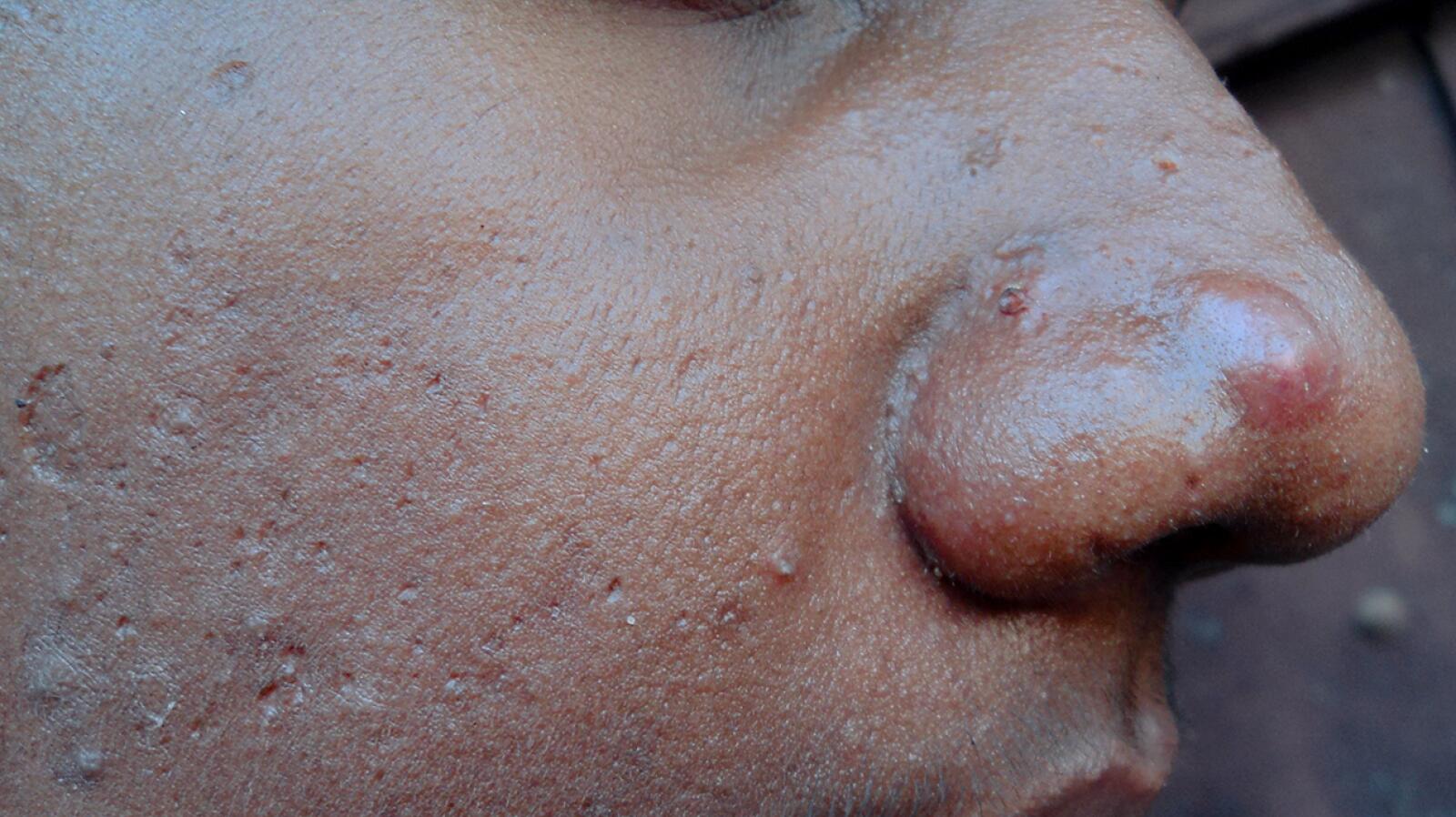 Sebum Plugs Causes, Skin Health, and Safe Removal