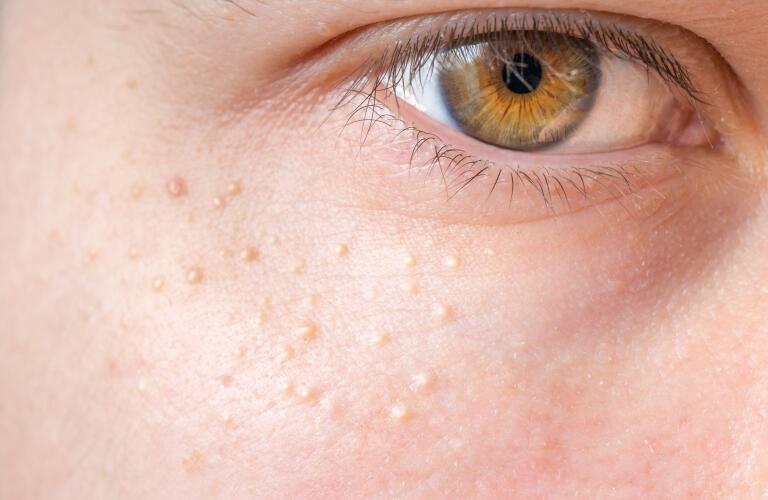 milia on skin around eye
