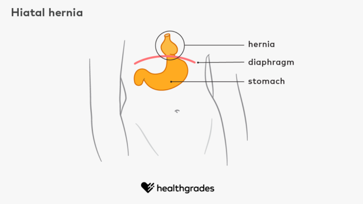 This diagram shows how the stomach pushes up through the diaphragm.