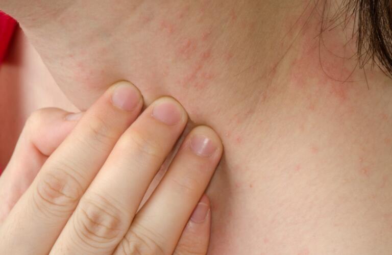 Atopic Dermatitis Symptoms, Triggers, Causes, Treatment and More