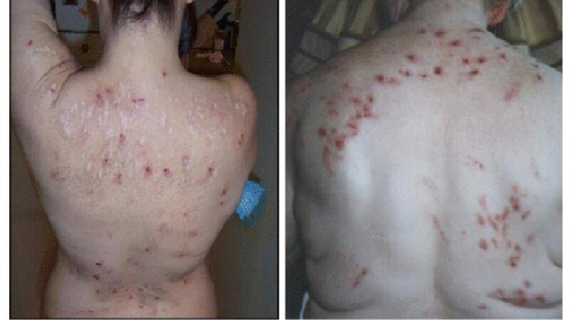 Medical photographs of Morgellons skin lesions on back