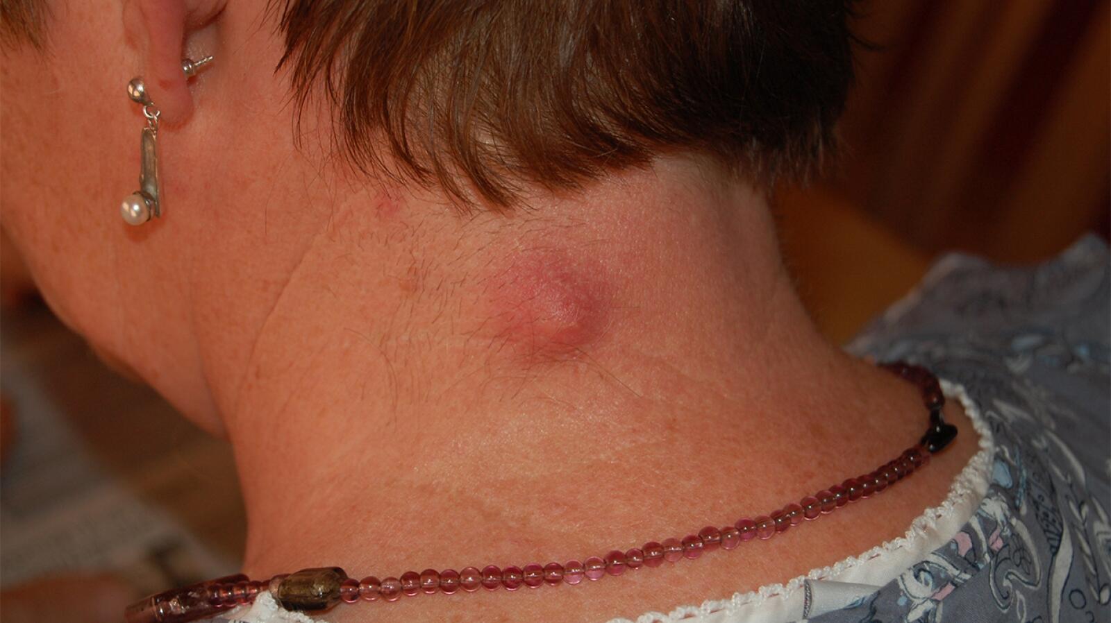 Epidermoid Cysts Causes Treatments And More epidermoid-cysts-causes-treatments-and-more