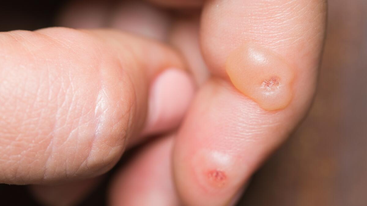 Warts: Types, Causes, Symptoms, Treatments & Removal - Healthgrades