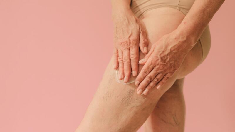 woman's leg with spider veins and varicose veins