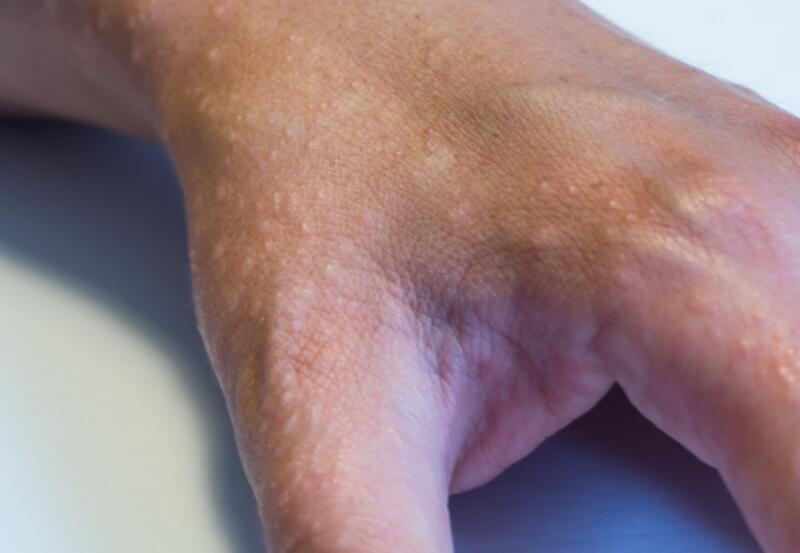 What Does Eczema Look Like? Pictures, Types, and More