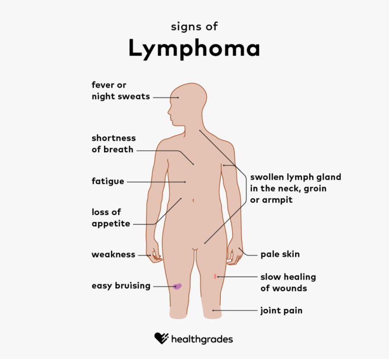Lymphoma: Symptoms, Causes, And Treatments