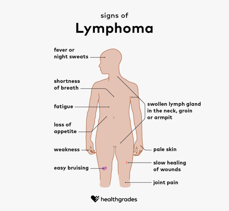 lymphoma