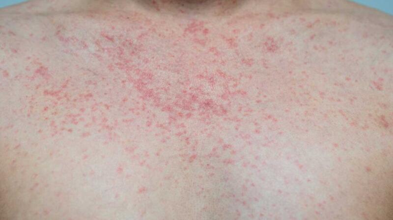 What Does an RSV Rash Look Like? Symptoms, Pictures, and Recovery