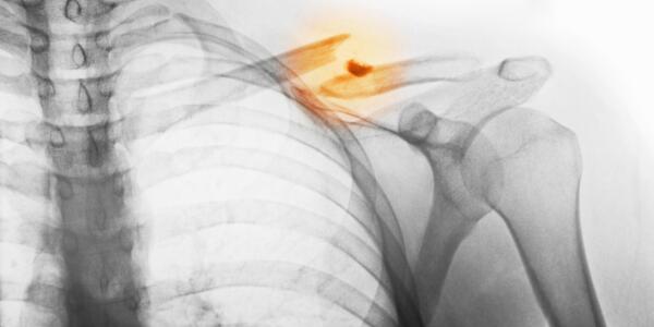 Most Painful Broken Bones Most Painful Broken Bones