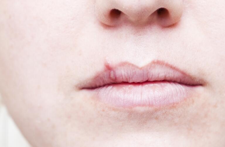 Close-up of cold sore on unseen Caucasian woman's lip
