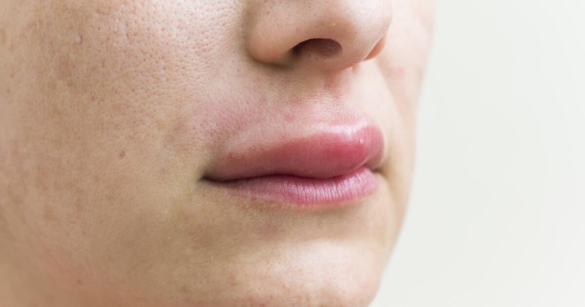 Angioedema: Definition, Symptoms, Causes, Treatment