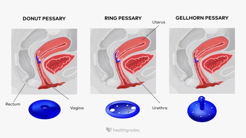 Pessary Definition Insertion And Care Tips