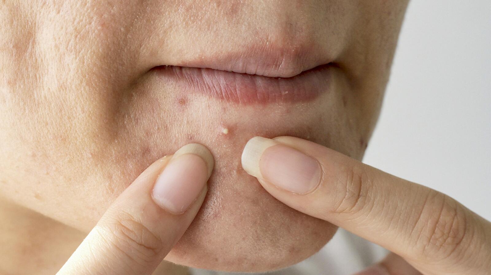 Whiteheads Causes, Pictures, and How to Get Rid of Them