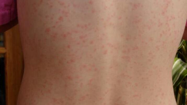 Red Spots On Skin Causes And Treatment