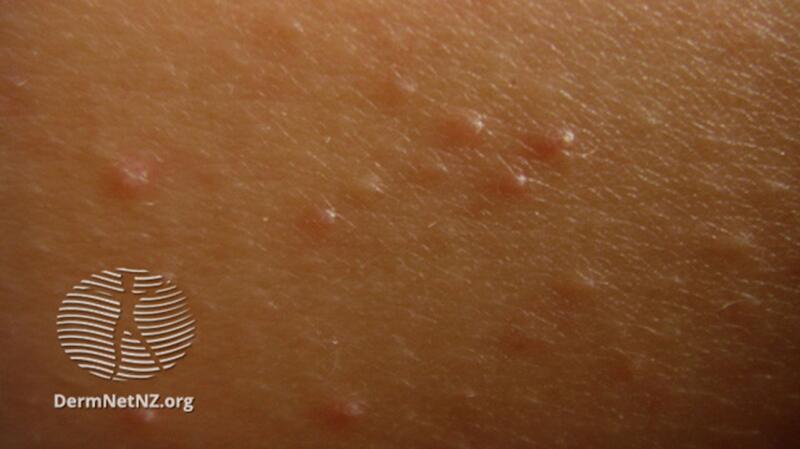 Keratosis Pilaris: Symptoms, Causes, and Treatment