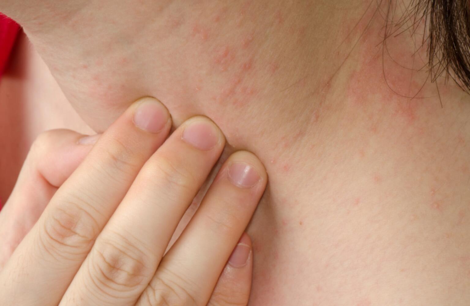 Contact Dermatitis Treatment What to Do for Contact Dermatitis