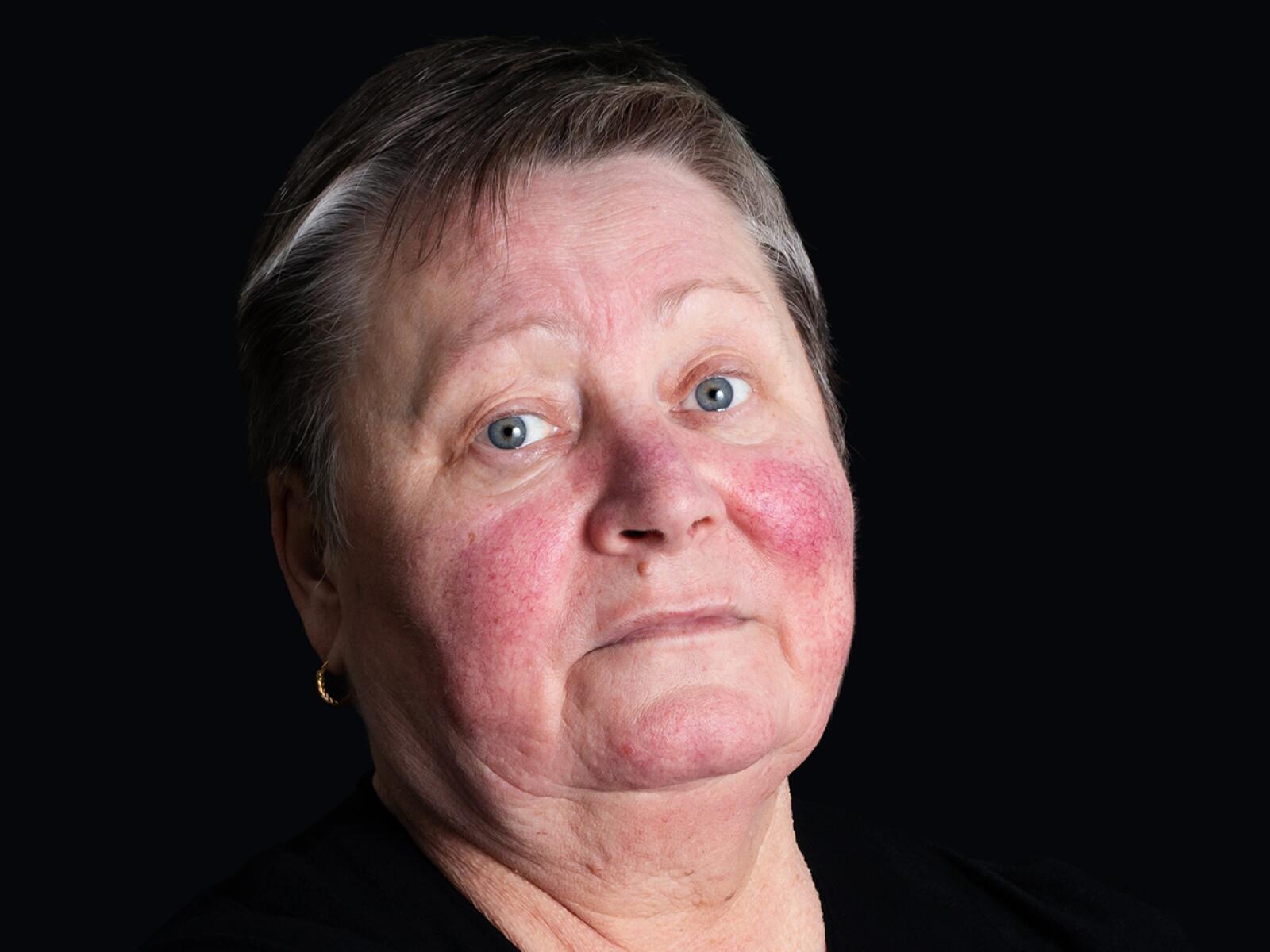 Butterfly Rash: Causes, Symptoms, Treatments