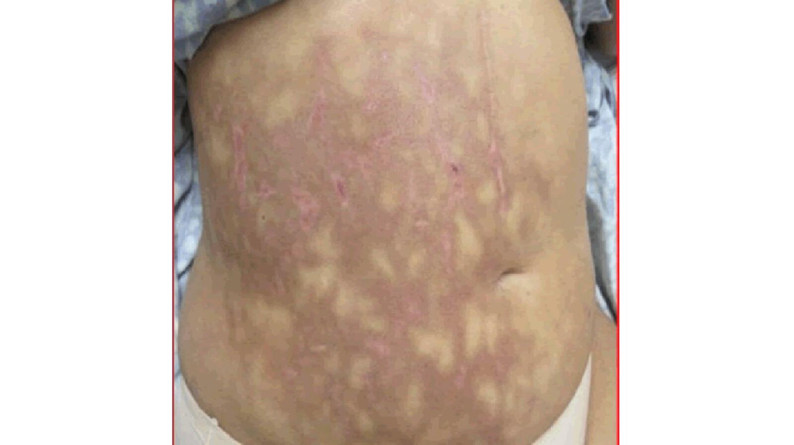 Mottled Skin Livedo Reticularis Causes Signs And Treatment