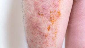 Weeping Rashes Weeping Eczema: Symptoms, Causes, and Treatments