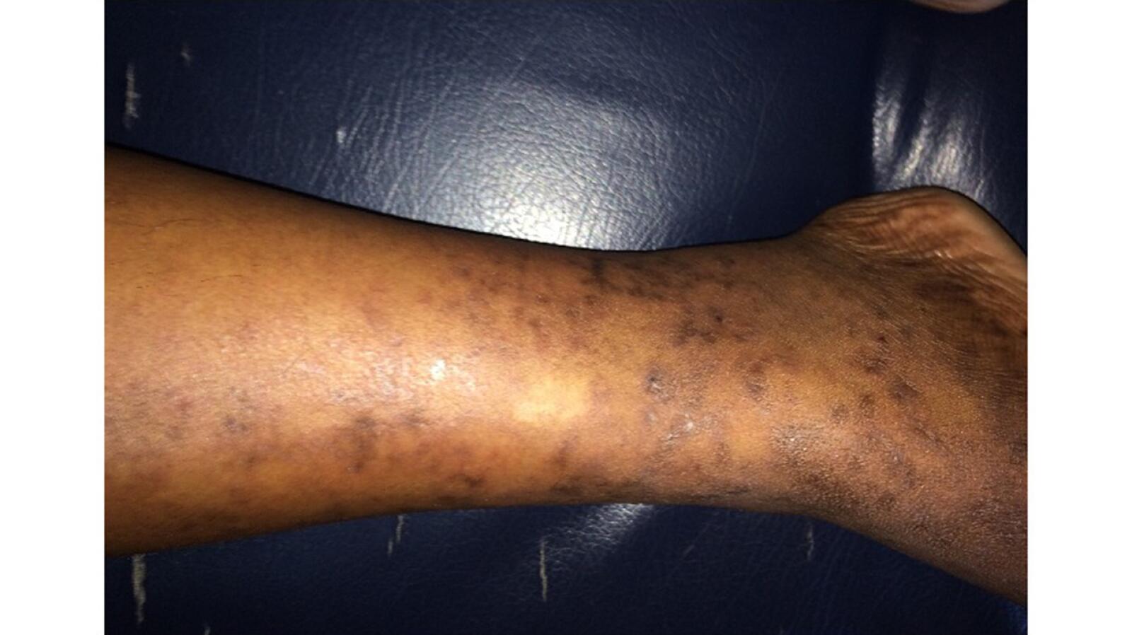 Mottled Skin Livedo Reticularis Causes Signs And Treatment 7177