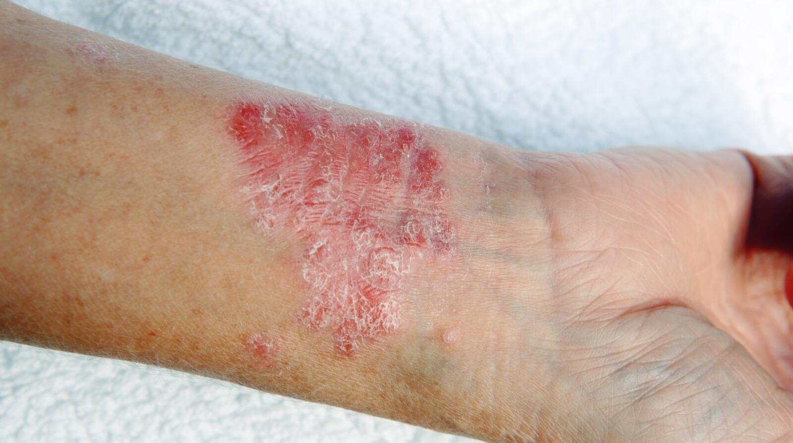 4 Signs Your Psoriasis Treatment Isn't Working