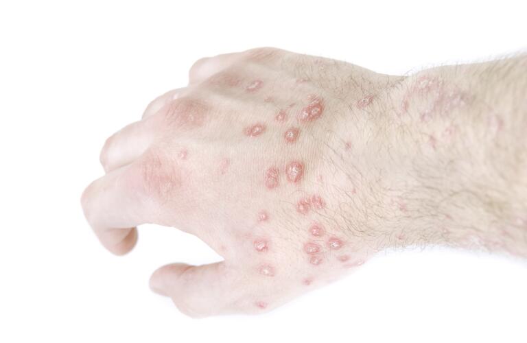 guttate psoriasis on man's hand and wrist