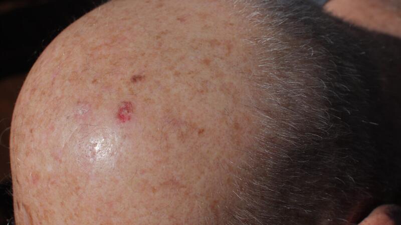 A red spot with a crust due to actinic keratosis on a person's head.