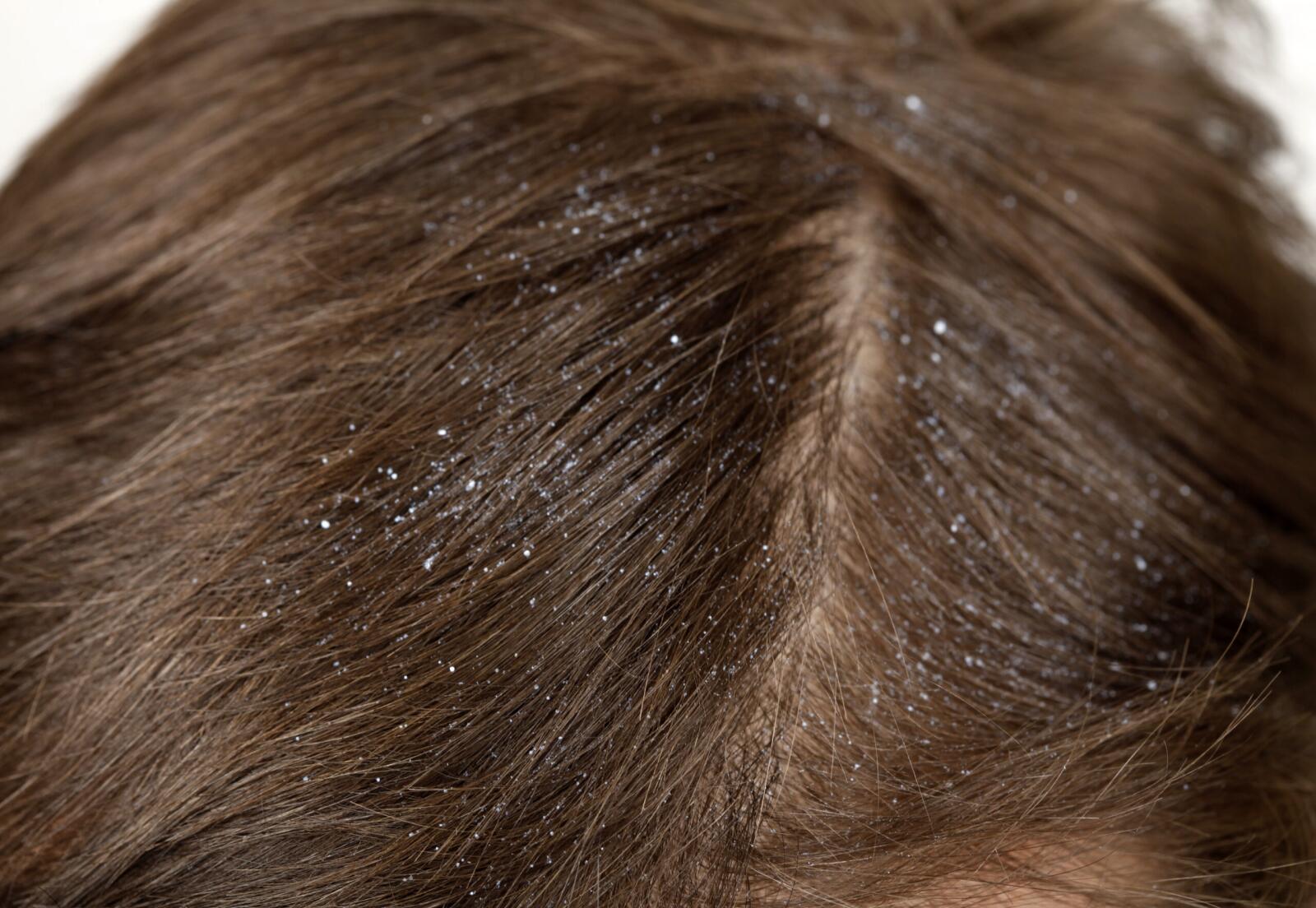 Scalp Psoriasis Vs Dandruff Comparison And Treatment 