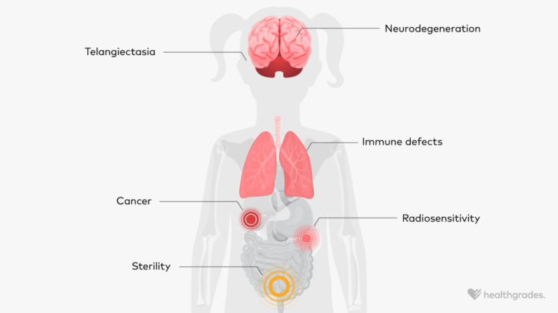 illustration of body areas afffected in ataxia telangiectasia