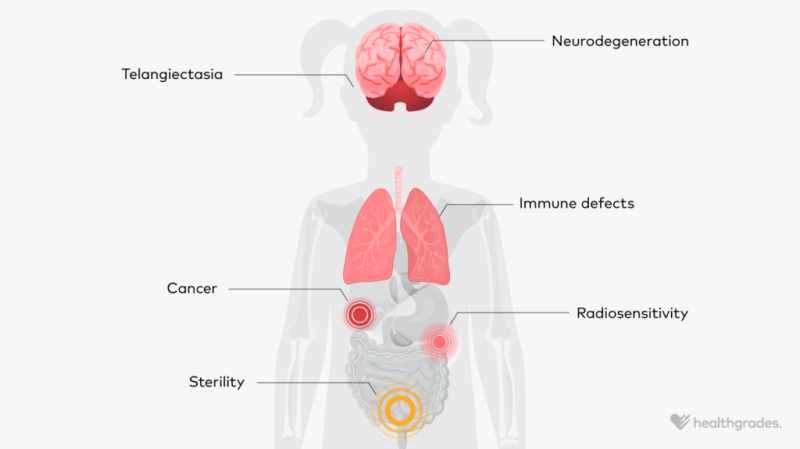 ataxia telangiectasia brain