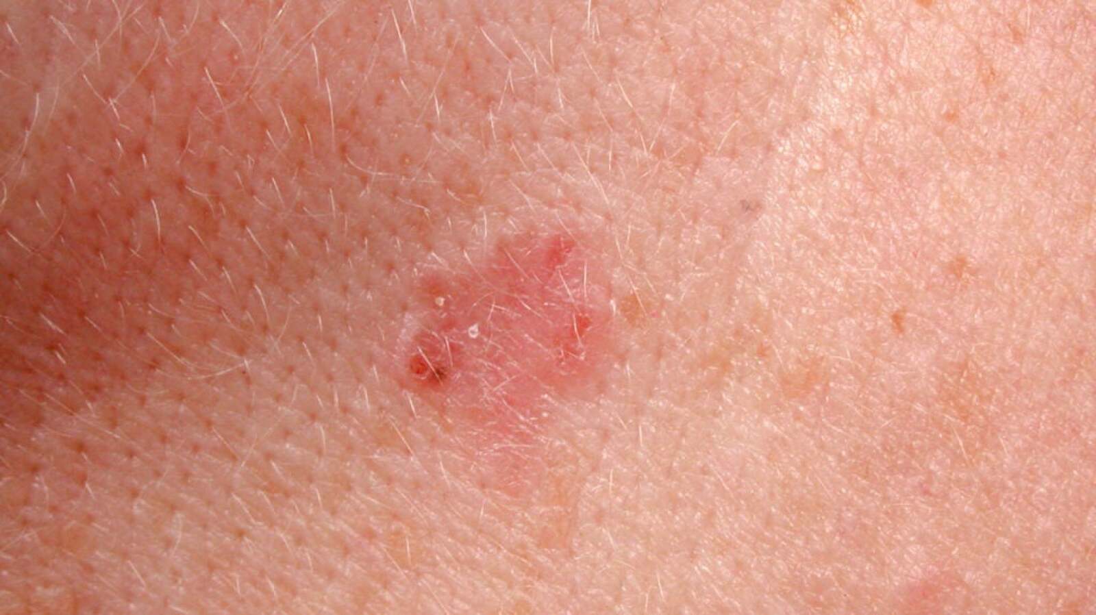 Images of Basal Cell Carcinoma: Pictures, Diagnosis, and More