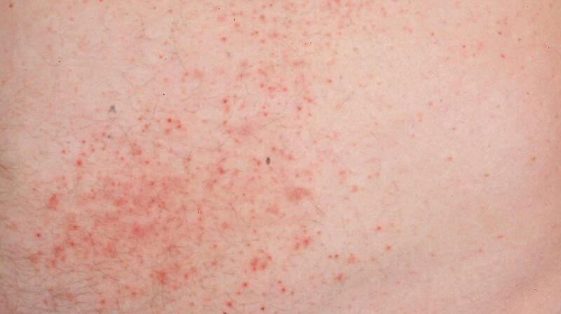 Dermatitis Herpetiformis Rash): to Know