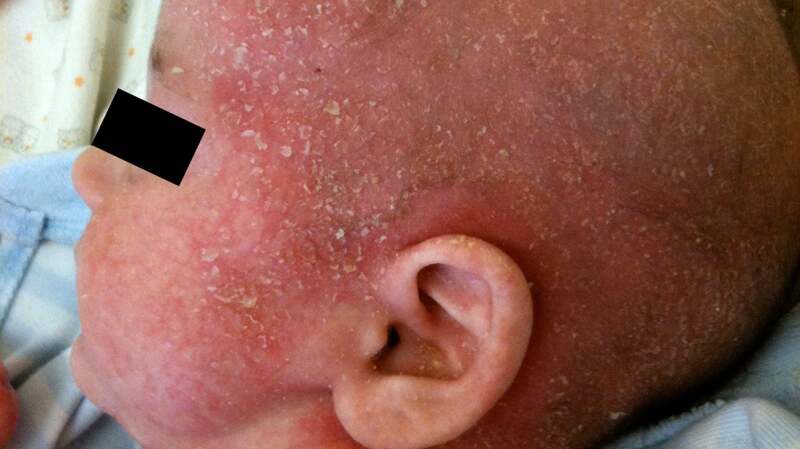 A medical image of atopic dermatitis.