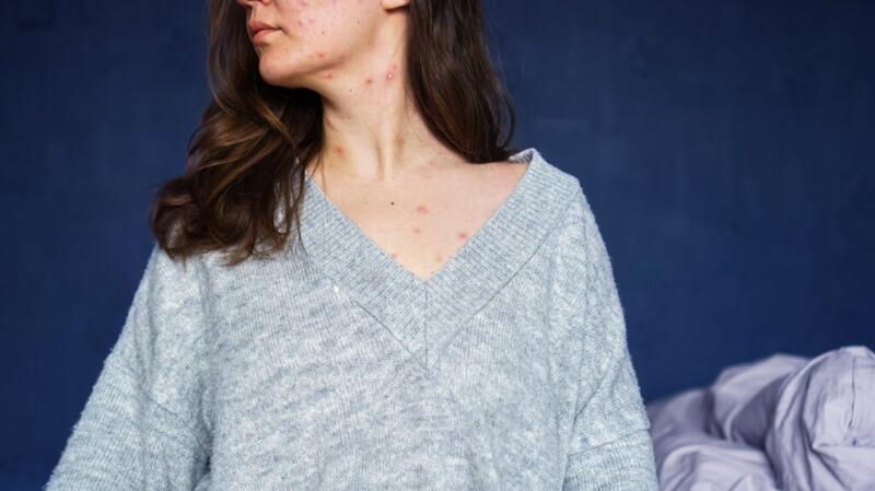 A person sits on a bed, turning their head to the side. Their skin shows visible acne from their collarbone to their face.