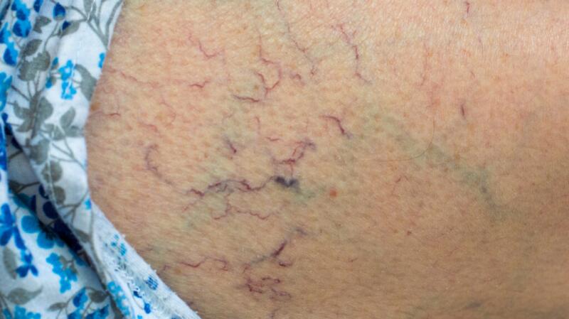 closeup photo of spider veins, or telangiectasias