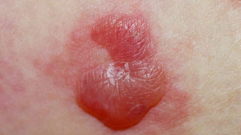 Image of bullous pemphigoid