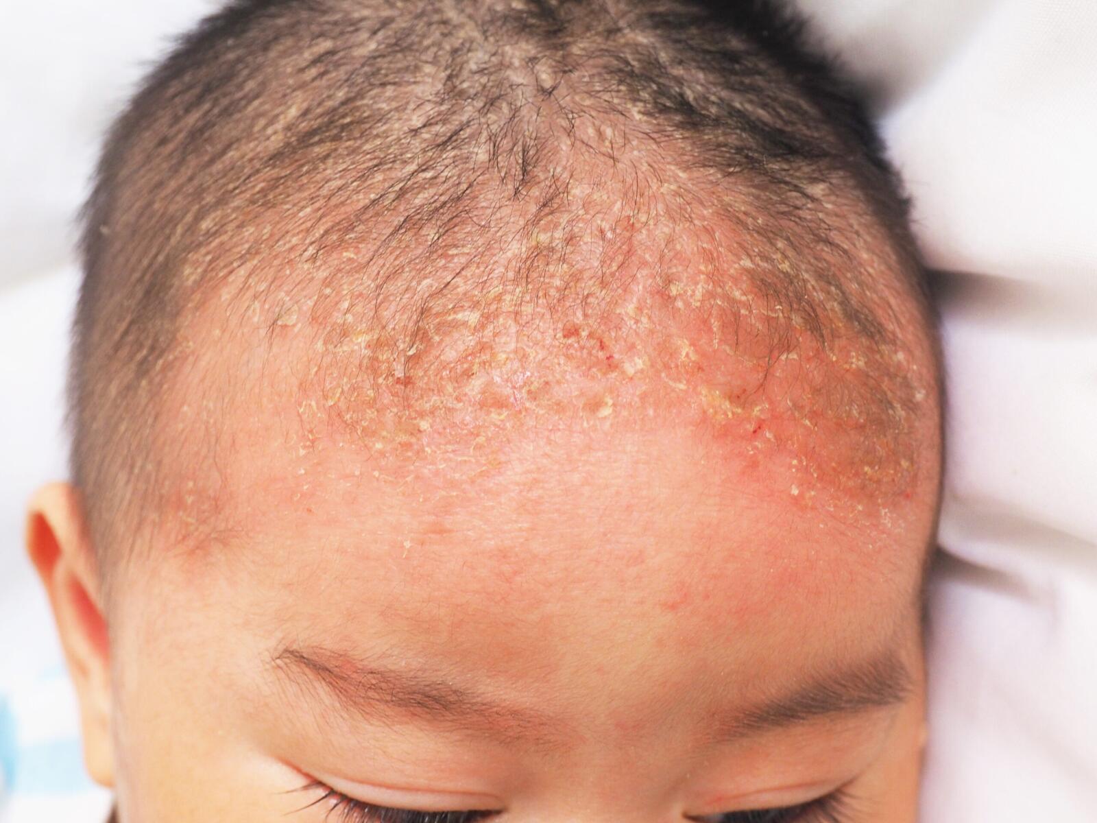 Seborrheic Dermatitis: Symptoms, Treatments, and More